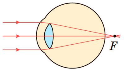 Далекозорість (гіперметропія)