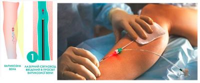 Оптоволоконний кабель. Застосування в медицині