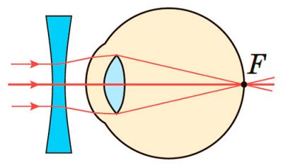 Короткозорість коригується окулярами із розсіювальними лінзами