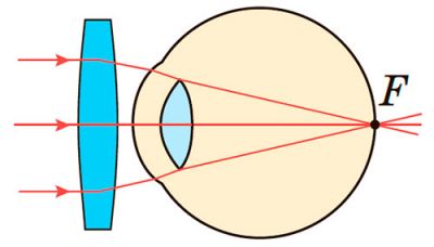 Далекозорість коригується окулярами зі збиральними лінзами